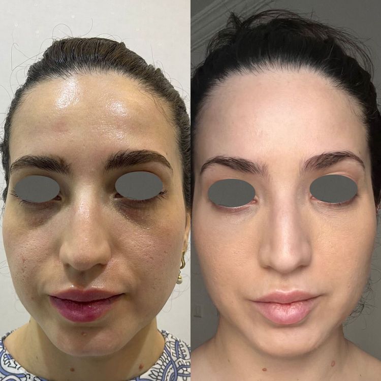 Skin Texture Enhancement